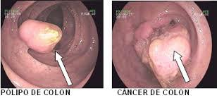 tumor-de-colon-y-recto-6