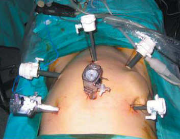 laparoscopia-microcirugia-laser-5