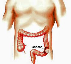 tumor-de-colon-y-recto-2
