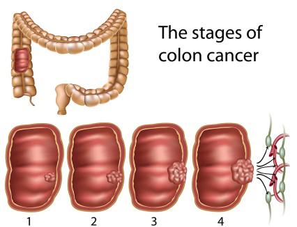 tumor-de-colon-y-recto-3