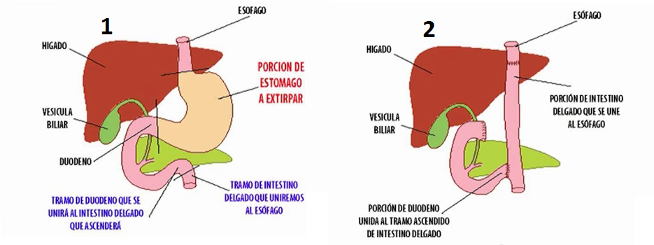 tumor-de-estomago-9