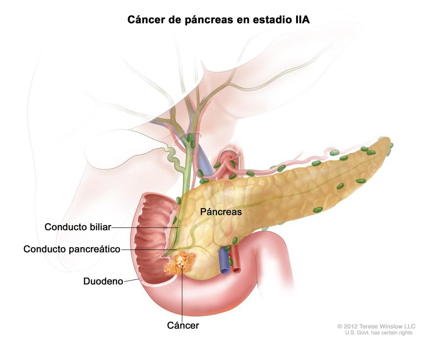 tumor-de-pacreas-2